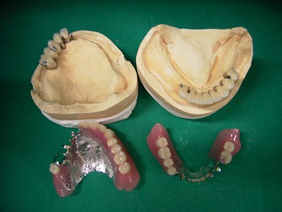 BPS義歯