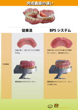 完成義歯の違い