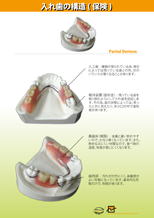 入れ歯の構造　保険